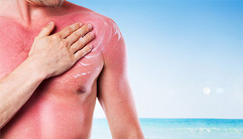Ako ošetriť spálenú pokožku od slnka?